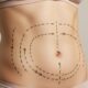 Abdominoplasty