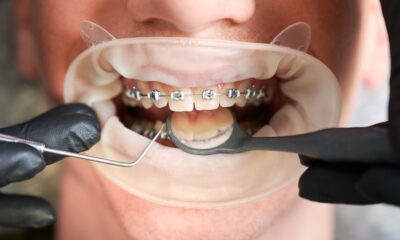 Braces