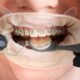 Braces
