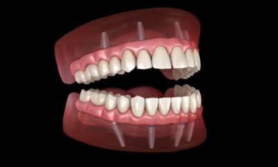 Dental Implants