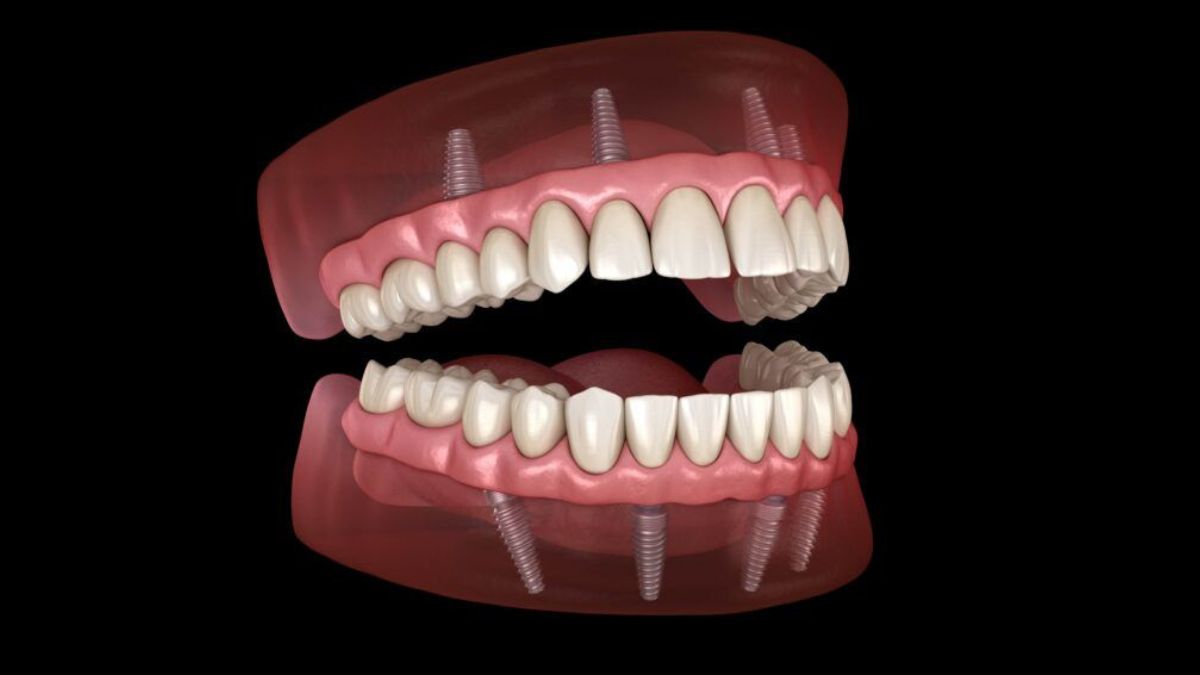 Dental Implants