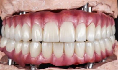 Dental Implants