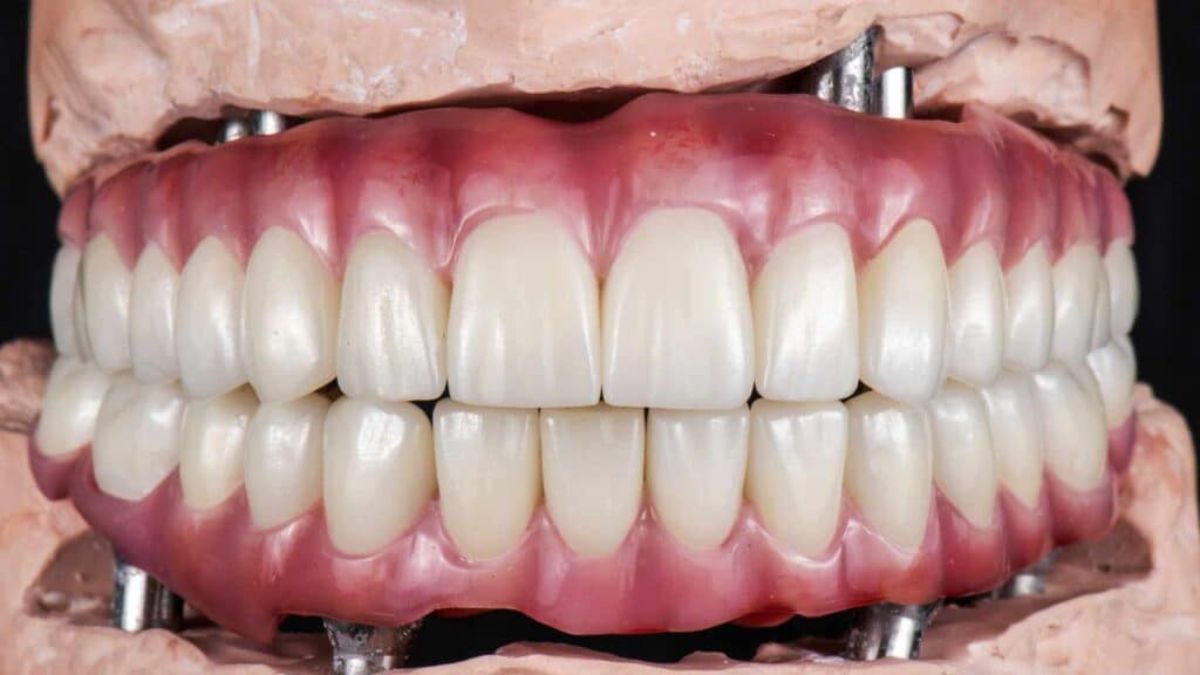 Dental Implants
