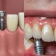 Dental Implant