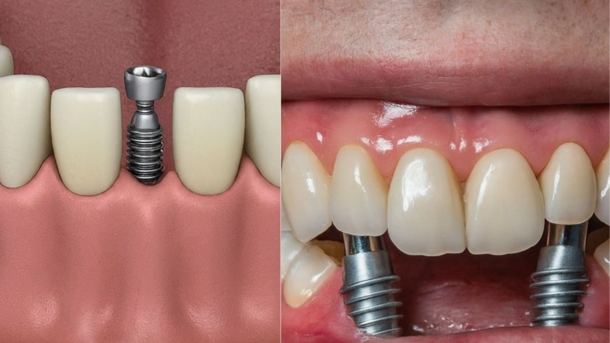 Dental Implant