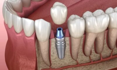 Dental Implant