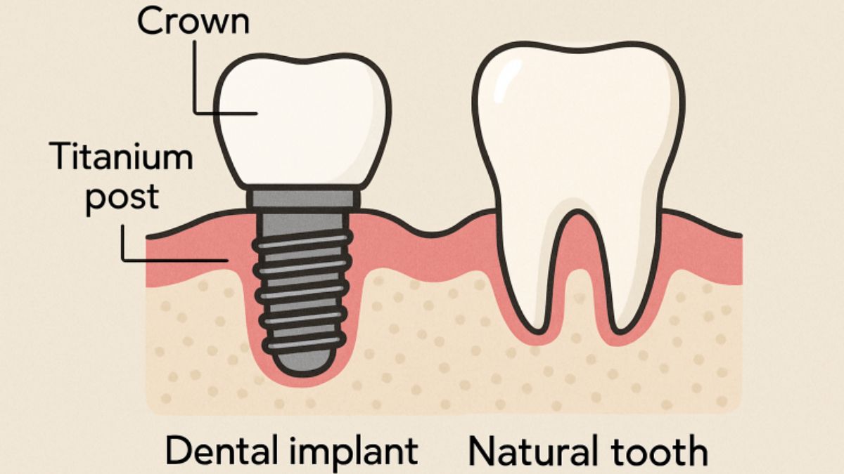 Dental Implants