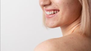Reducing Post-Acne Marks and Supporting Long-Term Clarity