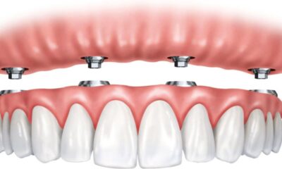 All on 4 Dental Implants