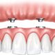 All on 4 Dental Implants