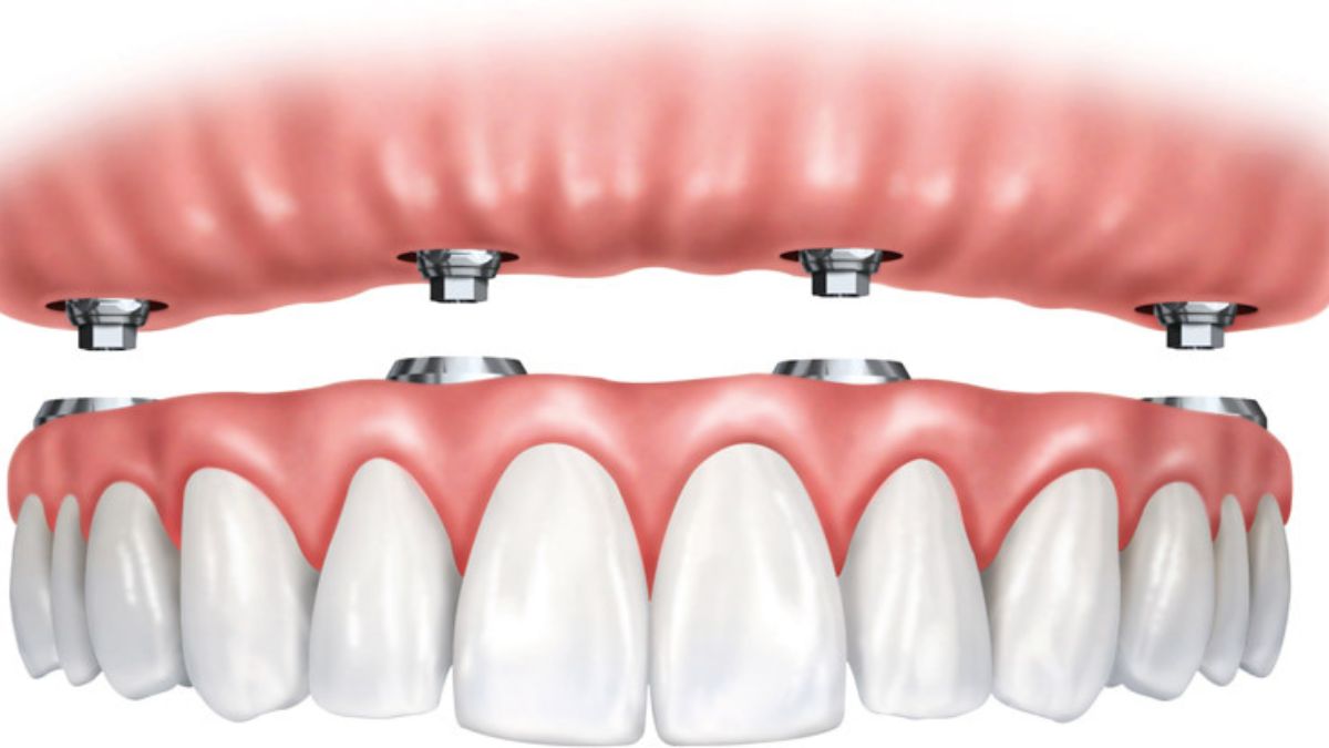 All on 4 Dental Implants
