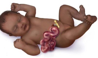 gastroshiza