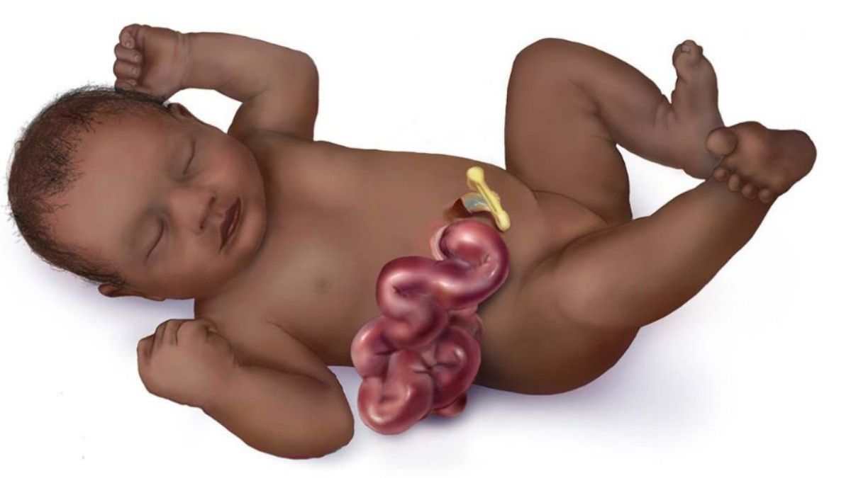 gastroshiza