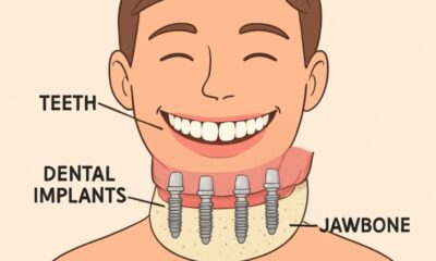 Full Mouth Dental Implants
