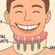 Full Mouth Dental Implants