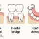 Single Dental Implants