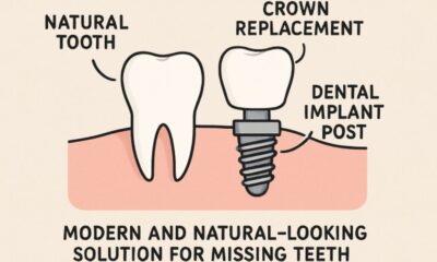 Dental Implant