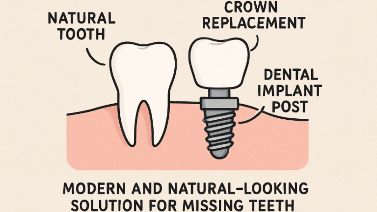 Dental Implant
