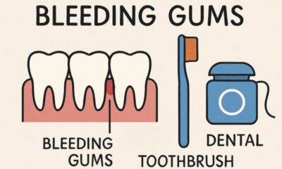 Bleeding Gums