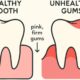 Gum Health