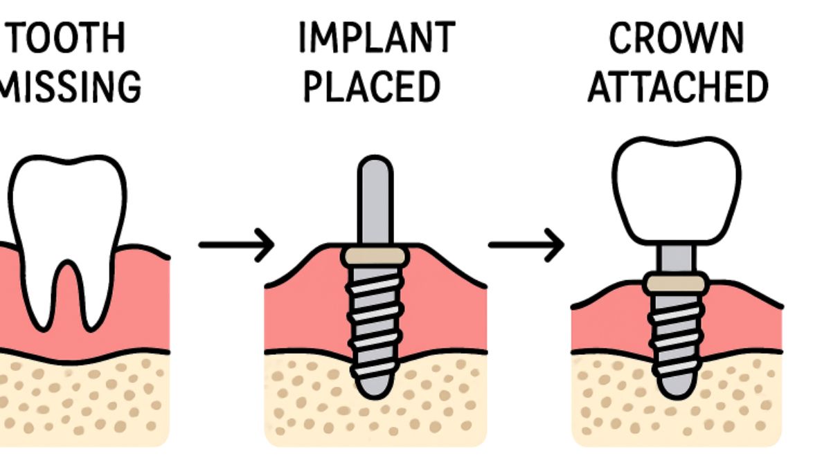 Dental Implants
